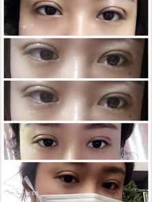 日本双眼皮手术恢复全过程