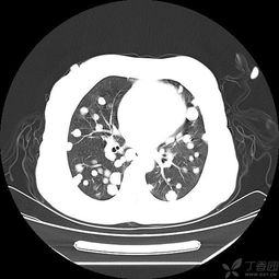 发一个 乳腺癌 肺转移的 病例