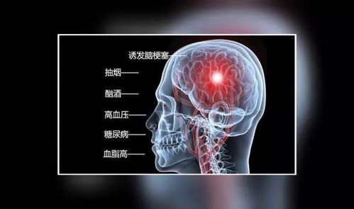 热成像ct可以检查脑梗