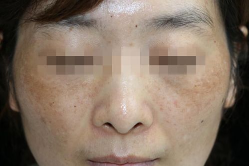 女人脸上妊娠斑怎么淡化 信息阅读欣赏 信息村 K0w0m Com