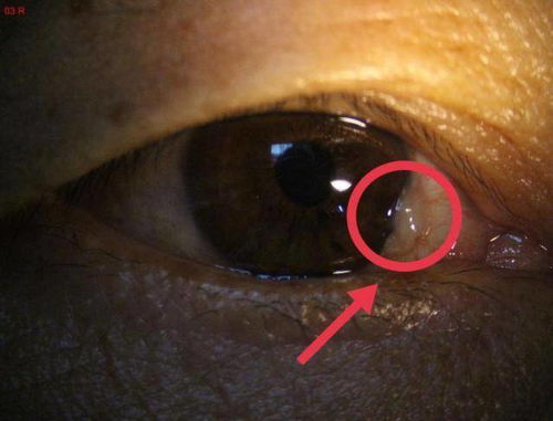 警惕眼内膜状物生长,眼科专家 胬肉除带来不适还很伤眼