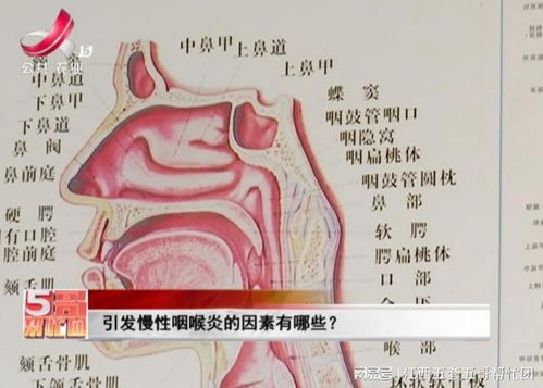 引发慢性咽喉炎的因素有哪些