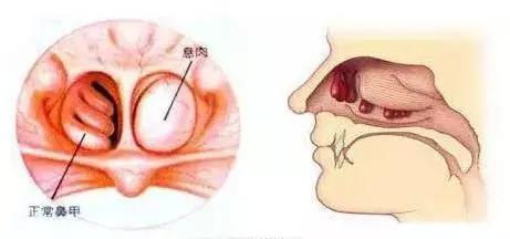 鼻子里长了块肉,这是怎么回事