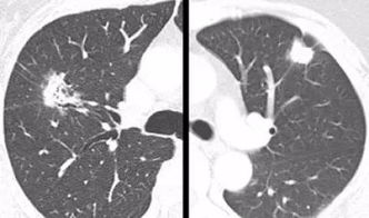 肺结节与肺癌的区别是什么该如何预防(肺结节和肺癌是一回事吗)