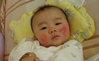 小儿湿疹图片，宝宝湿疹的图片
