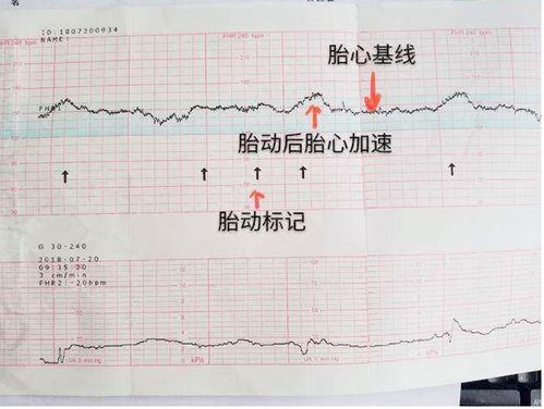 育网科普：胎心监护是什么？啥时开始测