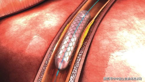 心脏支架骤降95 的背后,一个支架如何吃掉1万块钱回扣