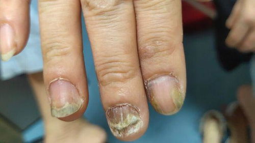 特比萘芬,能不能根治灰指甲 医生提醒 根治灰指甲,细节很重要