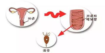 得滴虫性阴道炎的原因是什么？佛山哪家好