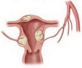子宫肌瘤的食疗方法？子宫肌瘤的食疗法