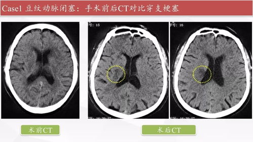 颅内支架是什么