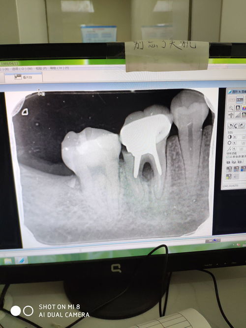牙医帮我看看牙片子,谢啦 