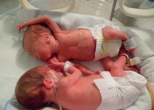 同卵双胞胎宝宝,却一起患上了婴幼儿急性白血病 