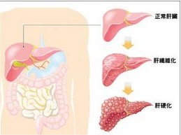 肝硬化腹水治疗需要多少钱