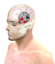 男子眼周上黑色素瘤扩散入脑 三次开颅仍无好转 