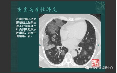 新冠患者ct图片（新冠患者胸部ct） 第1张