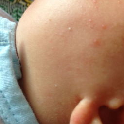 新生儿脸上起小白点像粉刺是怎么回事