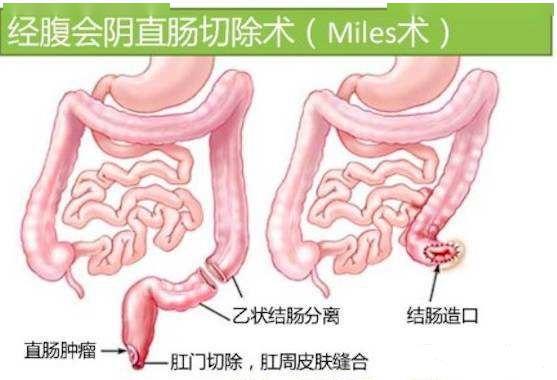 以为是痔疮便血,没想到是最恶的肿瘤,没坚持半年就去世了