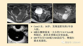 卵巢常见囊性病变影像诊断 