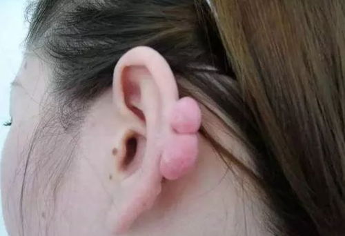 金沙人警惕 女子左耳打了四个耳洞,一年后耳朵竟然长出了两个球 