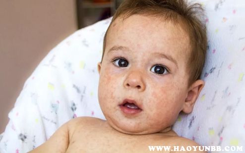 宝宝湿疹吃什么奶粉？婴儿湿疹吃什么奶粉