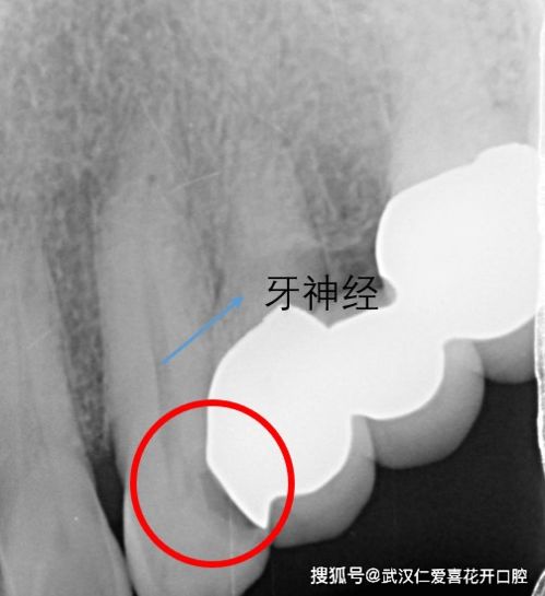 武汉仁爱口腔 牙齿龋坏 蛀牙 的样子以及处理方法