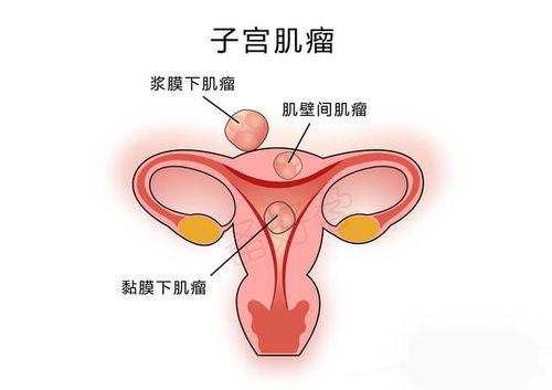 子宫肌瘤最怕三个运动(子宫肌瘤运动需要注意哪些问题)