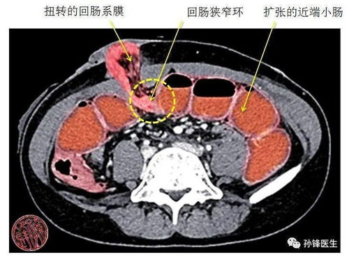 医学课堂︱直肠癌术后3天,末端回肠造口梗阻了,原因是什么