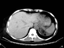 左肾错构瘤 Left renal hamartoma CT病例