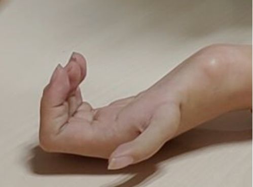 拇指发育不良漂浮拇,为什么不建议从脚上取骨头