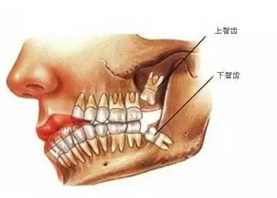 智齿疼怎么办，要不要拔