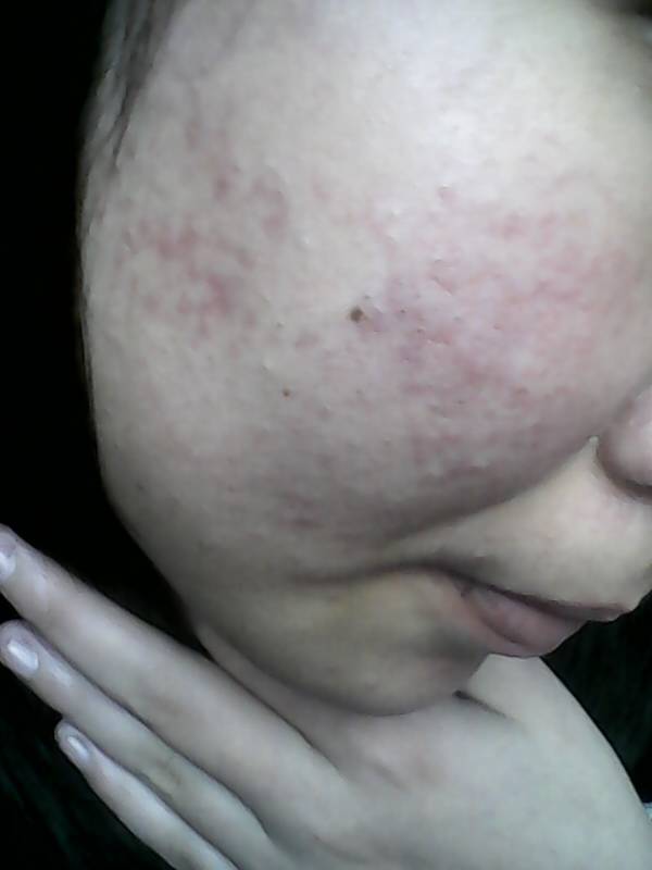 我朋友她脸上从去年七八月份分开始长了痘痘 起初以为是上火,没多在意,结果第二天从一大颗慢慢散播 