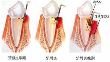 史上最全牙周炎知识 必收藏 