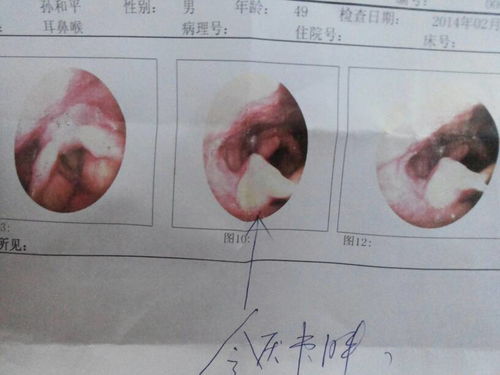 嗓子老有异物感做喉镜没事怎么办(嗓子异物感做喉镜没有问题吃饭不堵的原因)