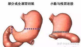 胃癌,如果把胃全部切除,能活多久 