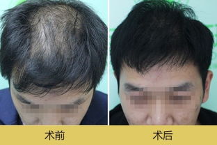 这种脱发属于什么类型的脱发 有什么方法预防和治疗 