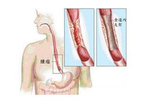 得了食道癌还能活多久