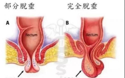 脱肛痔 什么叫下行吻合器痔上粘膜环切术？ 