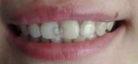 我上门牙有两颗的缝隙曾因清洁不彻底导致牙齿坏了,每颗牙的外围都坏了一点,后来曾修补填充过材料,但是 