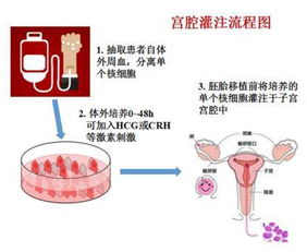 宫腔灌注(宫腔灌注是什么意思)