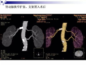 CT增强检查的临床意义 