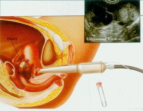 人工受孕过程，人工受精全过程
