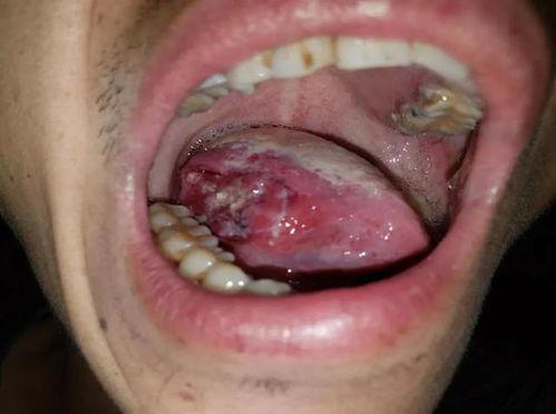 口腔溃疡癌症鉴别