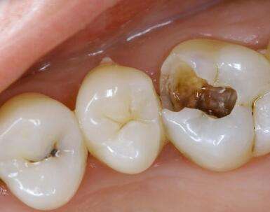 北京精德口腔补牙医生经验分享 补牙要分多次进行,这是为什么