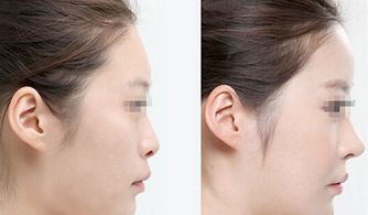 鼻子整形多久恢复自然--隆鼻手术后多久可以恢复自然啊？