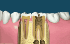 根管治疗后,牙齿还能用多久