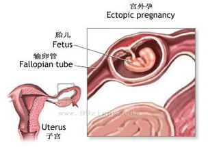 什么是宫外孕