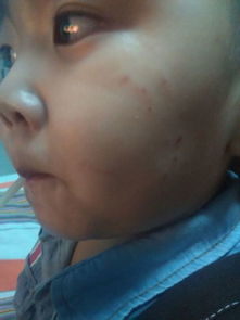 2岁半的孩子在幼儿园被抓伤,脸上很多伤口,看看会不会留疤 