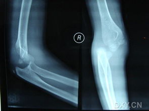 左肘关节脱位合并肱骨内髁骨折 信息图文欣赏 信息村 K0w0m Com