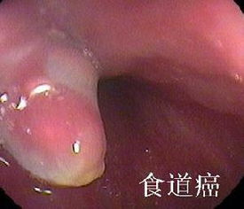 食管癌的六大护理措施